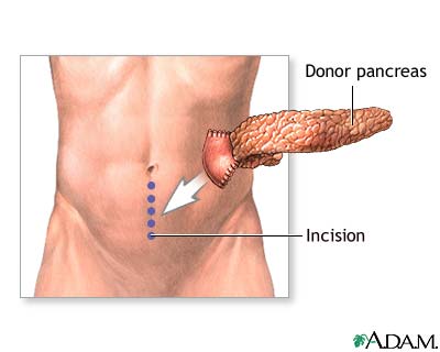 Incision