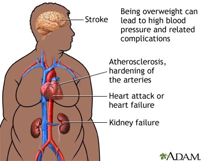 Obesity and health