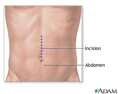 Incision